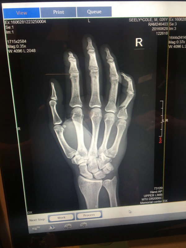 An X-ray of Seely's hand.